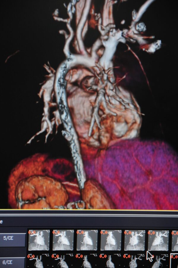 Cardiac CT Scan