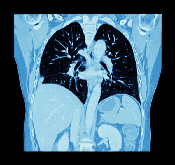 CT Lung Tumors, 3-D Reconstruction