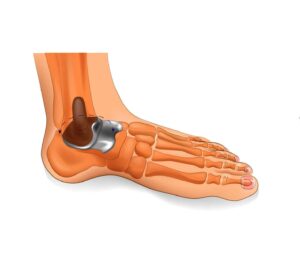 ankle joint replacement