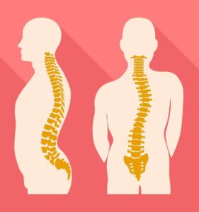 scoliosis of the spine