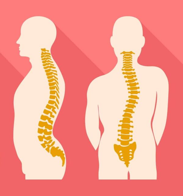 scoliosis of the spine