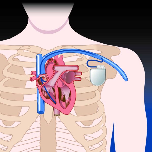 Cardiac Rhythm Device Infections – CT Imaging and Replacement Timing