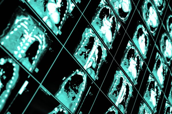 Chest CT in Blunt Trauma