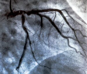 coronary artery anatomy