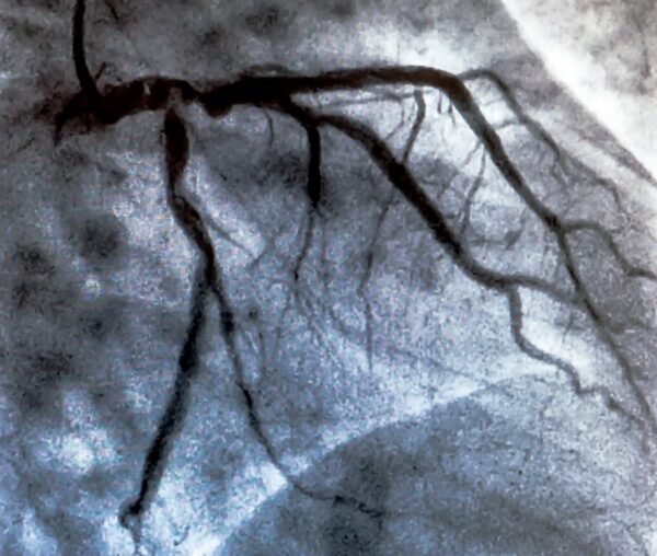 Coronary Angiography Indications