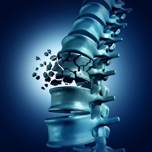 picture of spine fracture