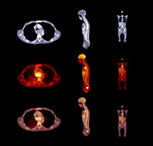 PET-CT Scan
