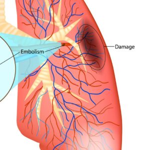 CT scan of lung