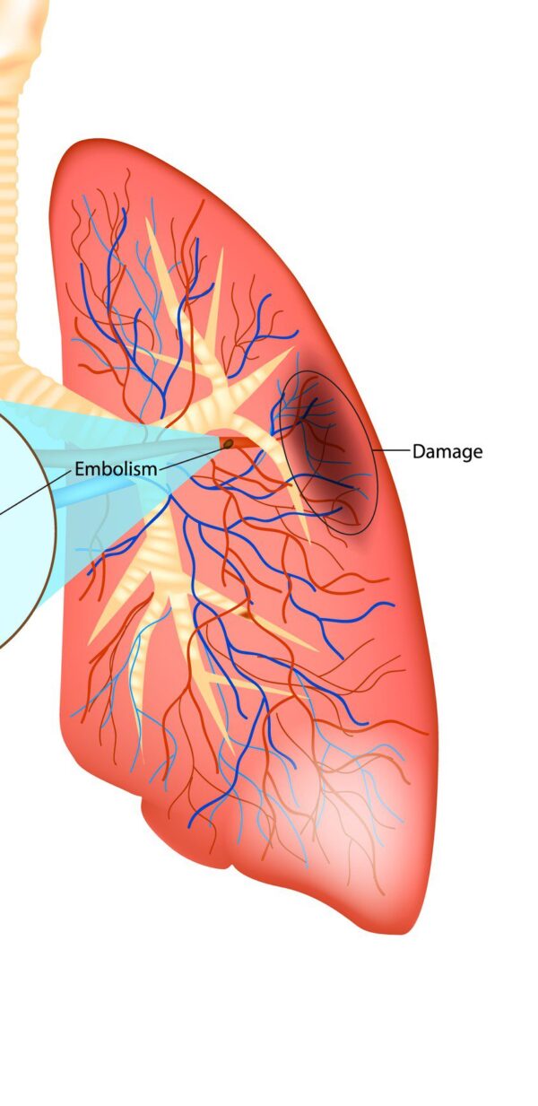 CT scan of lung