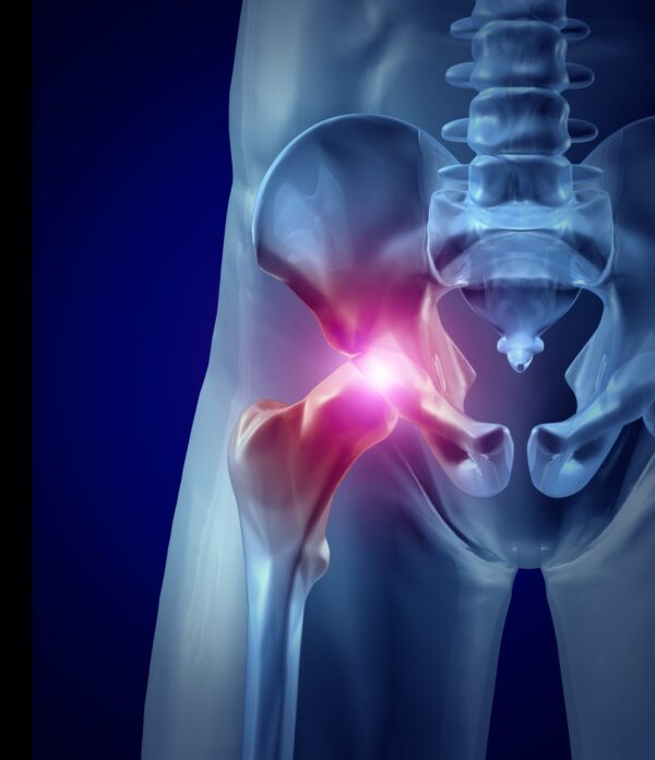 hip replacement picture