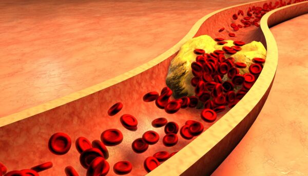 Understanding the Mechanisms of Coronary Artery Disease