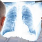 doctor looking at a chest x-ray.