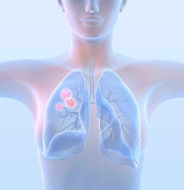 Lung Cancer Screening Challenges